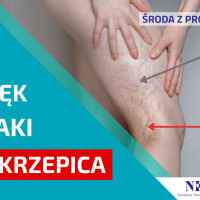 Zdjęcie: noga pokryta zylakami. Tekst w ramce: Obrzęk żylaki zakrzepica