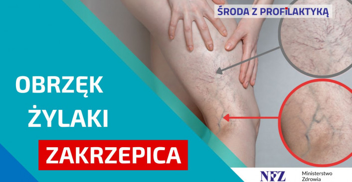 Zdjęcie: noga pokryta zylakami. Tekst w ramce: Obrzęk żylaki zakrzepica